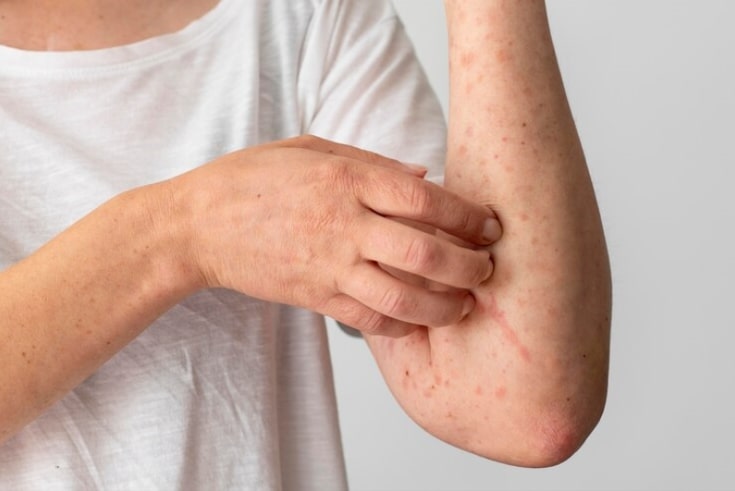 The Role Of An Allergist In Treating Eczema