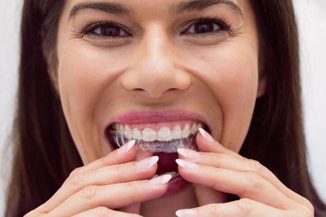 Invisalign Clear Aligners